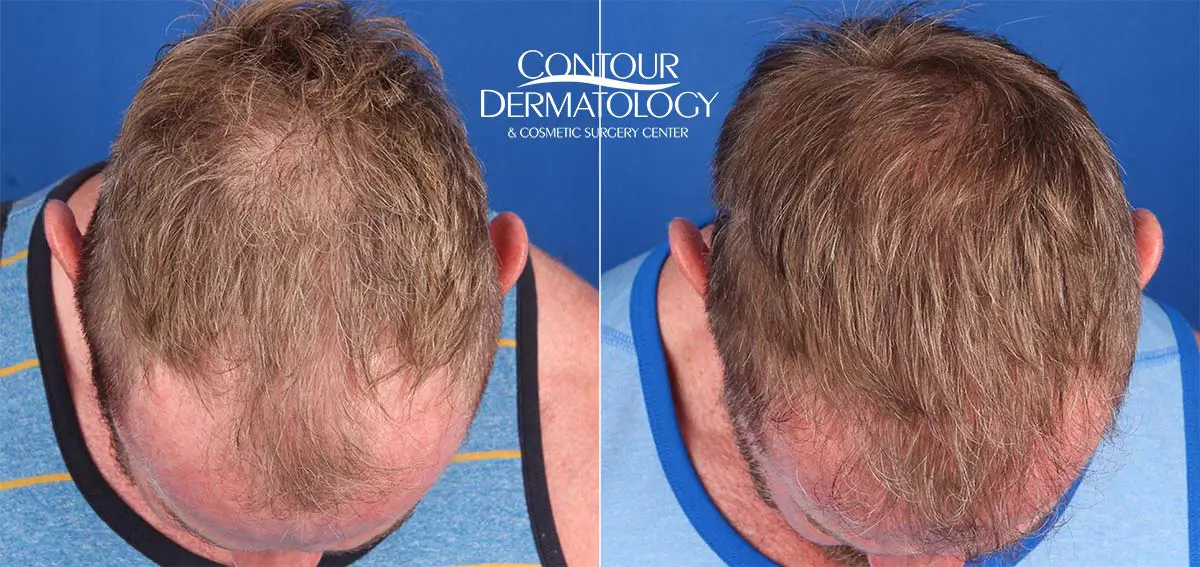 20190308-hair-transplant-before-after-lg | Contour Dermatology