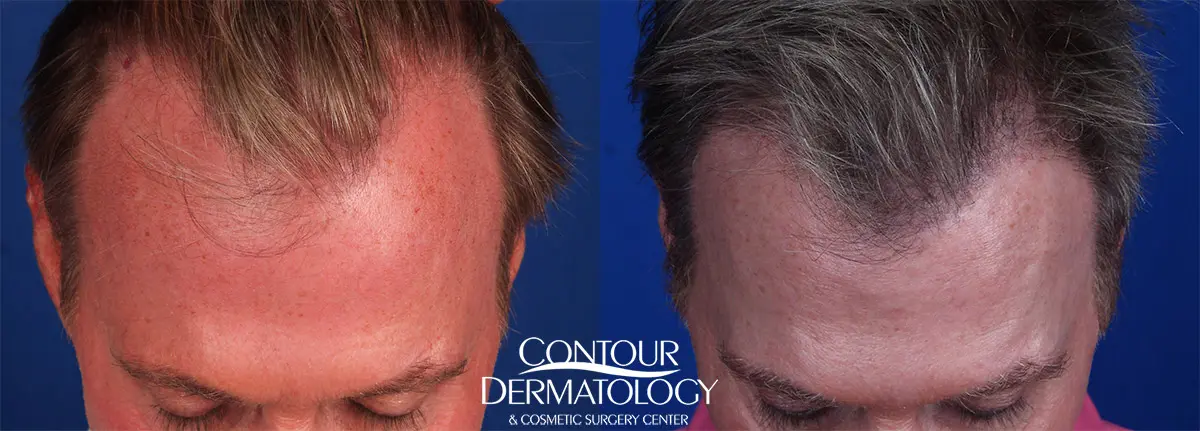 20190611-Hairtransplant-FUT-lg | Contour Dermatology
