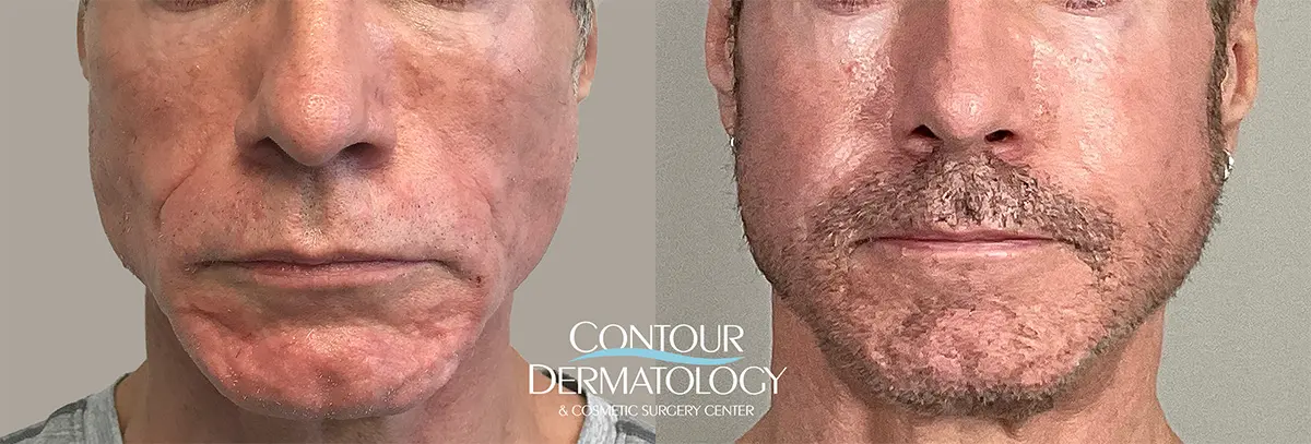 sculptra before and after
