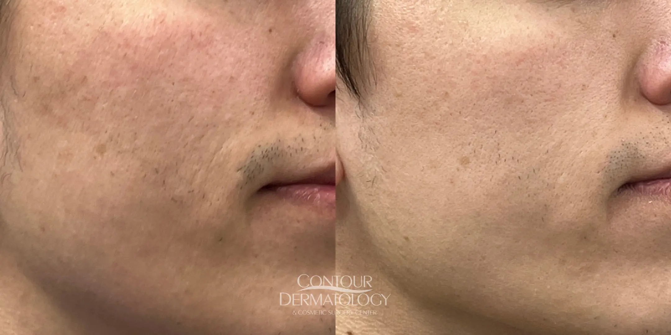 Hollywood peel before & after