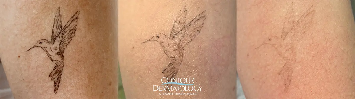 Before and after tattoo removal showing significant fading of a small heart tattoo after PicoWay laser treatment.