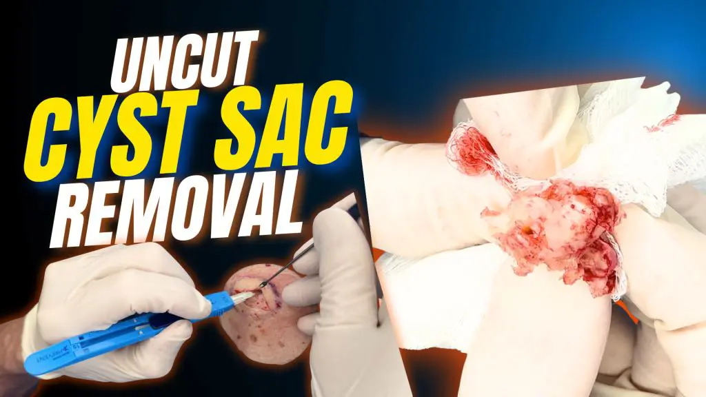 This video shows a real cyst extraction performed in a dermatology clinic. The footage is completely unedited — no music, no cuts, and no added effects.