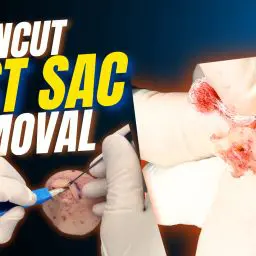 This video shows a real cyst extraction performed in a dermatology clinic. The footage is completely unedited — no music, no cuts, and no added effects.