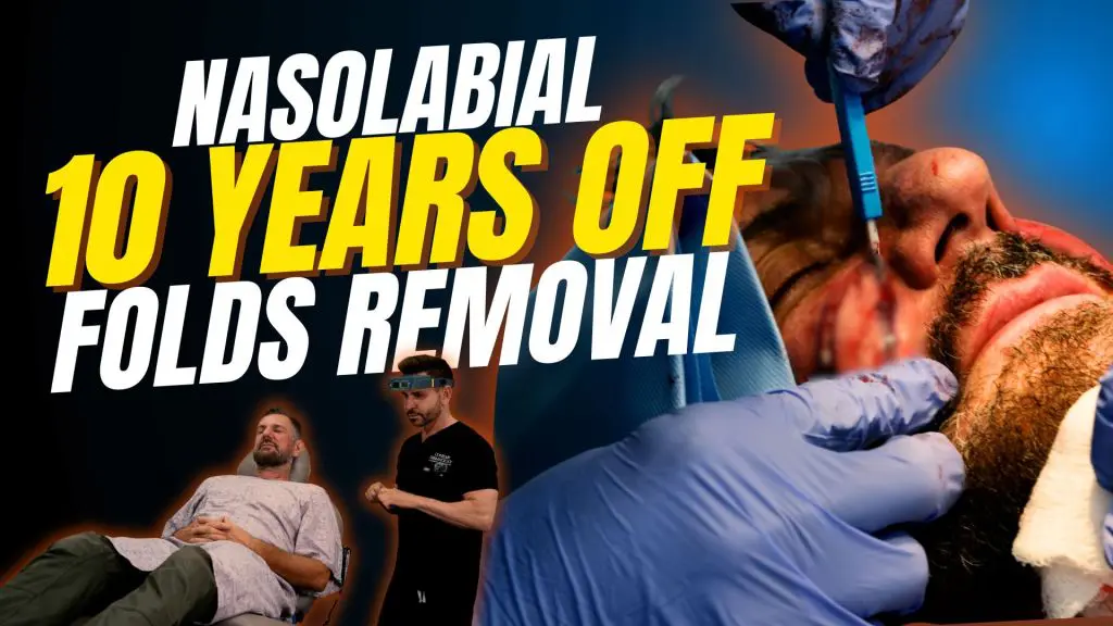 In this video, we break down why these folds form, what actually makes them look deeper over time, and how expert facial rejuvenation can dramatically refresh your appearance sometimes making patients look years younger when done correctly.