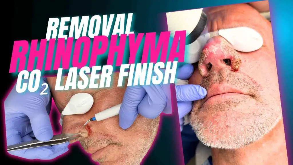 In this procedure, Dr. Jochen first removes the excess tissue using an electrosurgical incision tool, which allows for precise sculpting and controlled removal of the thickened skin. After the bulk of the rhinophyma tissue is reduced, a fractional CO₂ laser is used to further refine the surface and improve the overall contour and texture of the nose.