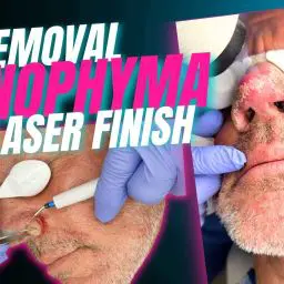 In this procedure, Dr. Jochen first removes the excess tissue using an electrosurgical incision tool, which allows for precise sculpting and controlled removal of the thickened skin. After the bulk of the rhinophyma tissue is reduced, a fractional CO₂ laser is used to further refine the surface and improve the overall contour and texture of the nose.