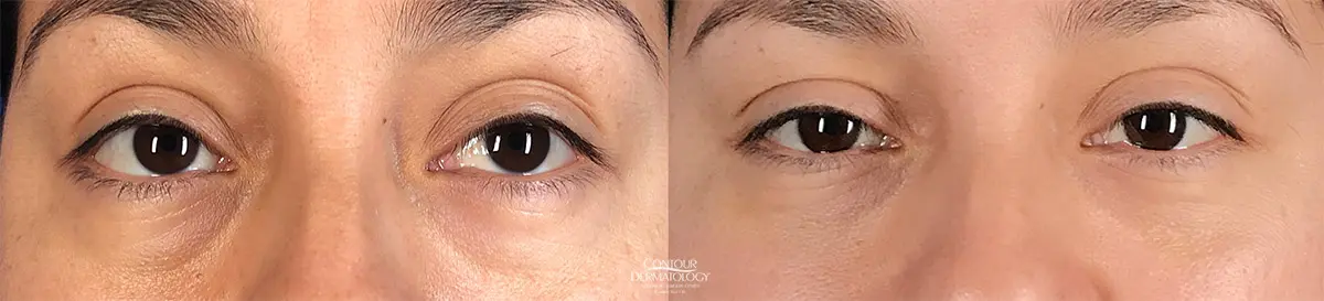 After Juvederm Vollure filler for under eye hollows