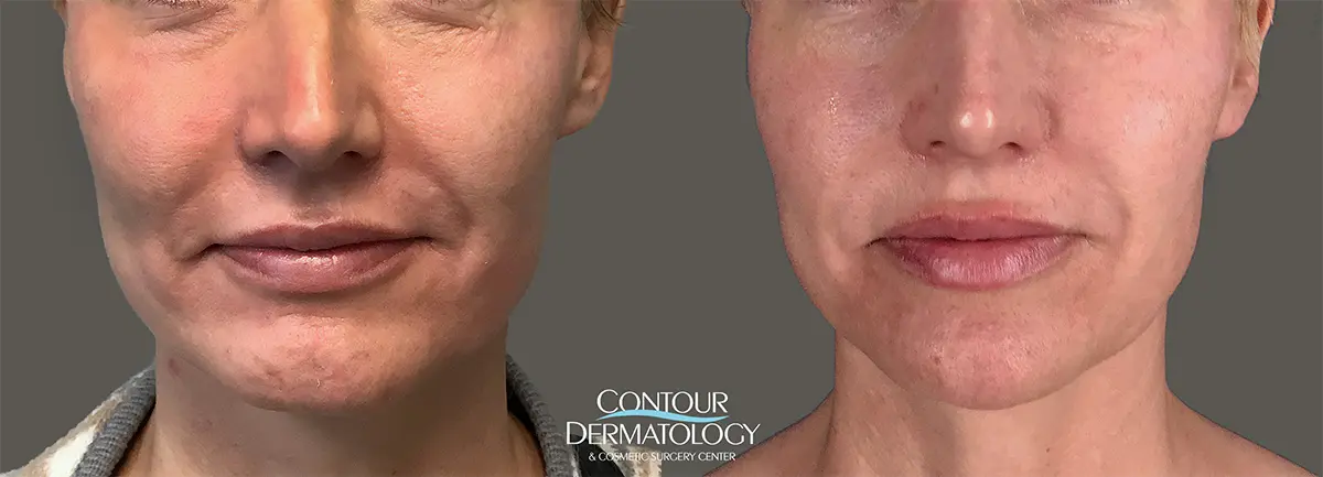 2 months after Restylane Defyne and Voluma filler to the chin, marionettes, corners of the mouth, lips, cheeks, and nasolabial folds