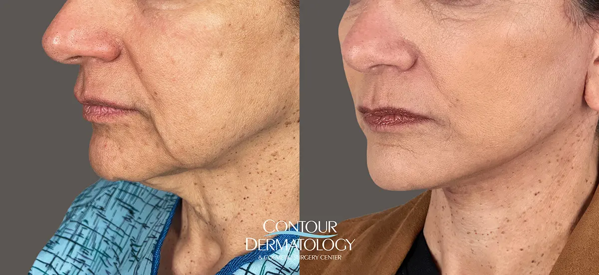 1 month after a Mini Facelift, 60-year-old Female