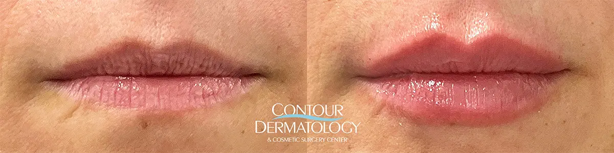 Immediately after Restylane Contour filler to the lips