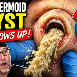 Watch as years of built-up material are squeezed from the cyst while Dr. Jochen carefully removes the sac to help prevent it from returning.