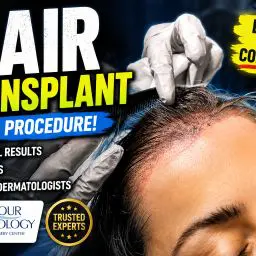 Watch a real hair transplant procedure performed inside a dermatology office as the Contour Dermatology team carefully works along the patient’s hairline.