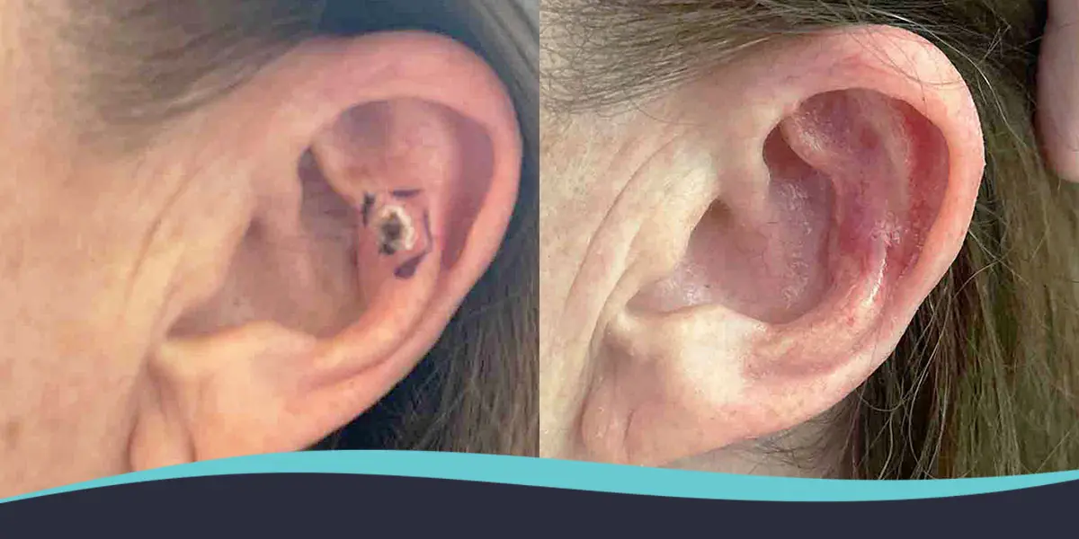 Before-and-after comparison of an ear: the left ear shows a repaired/healed earlobe with surgical change, the right ear appears healthy and intact.