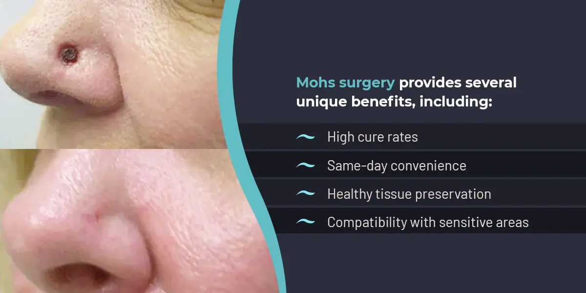 Close-up of a nose lesion with a dark panel listing Mohs surgery benefits: high cure rates, same-day convenience, tissue preservation, sensitive-area compatibility.