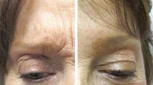 Botox Before/After Gallery