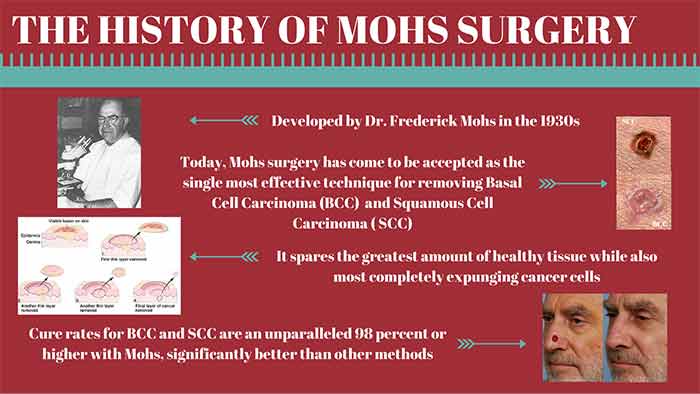 History of Mohs Surgery