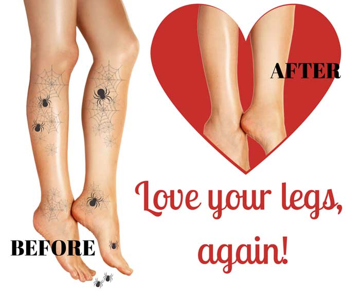 Can You Tattoo Over Varicose And Spider Veins  Tattify