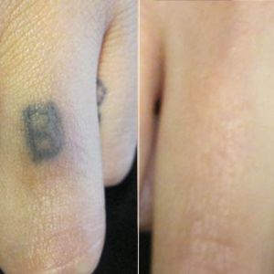 Laser Tattoo Removal on Finger Before and After