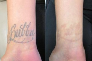 Laser Tattoo Removal | Contour Dermatology
