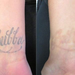 Laser Tattoo Removal on Wrist Before and After