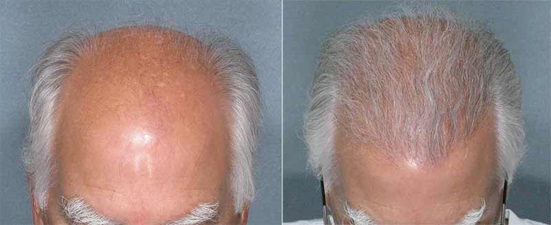 Hair Transplant and Restoration Before and After Photos