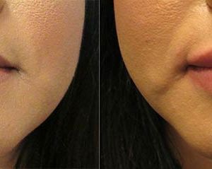 Restylane for lips