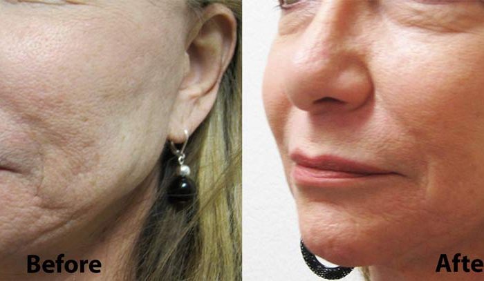 Restylane for Cheeks