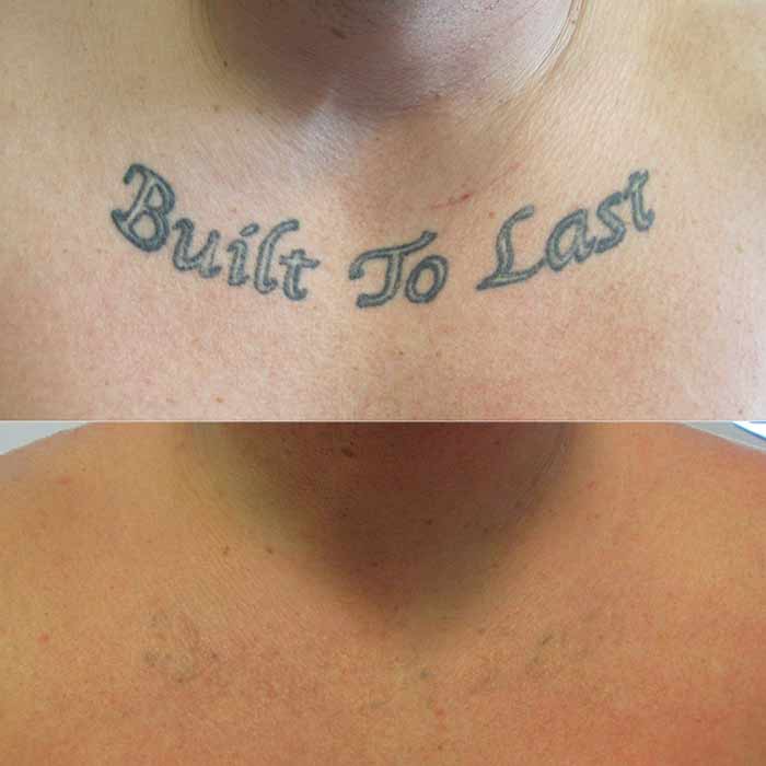 12 sessions over 3 years  rTattooRemoval