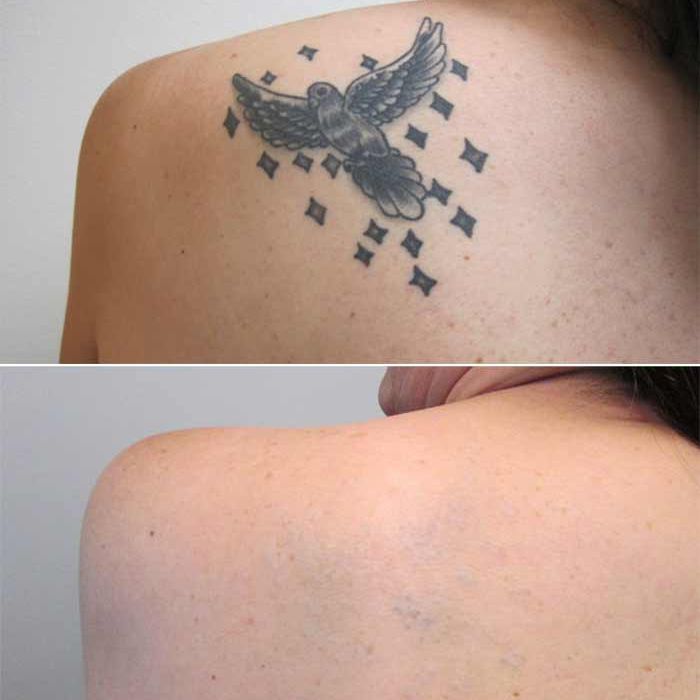 Tattoo Removal on Back Before and After