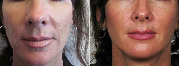 Facial Filler Before and After