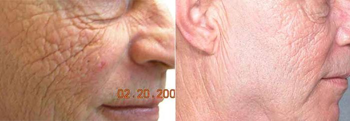 Fractional CO2 Before and After