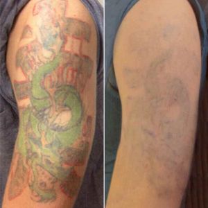Tattoo Removal on Arm Before and After