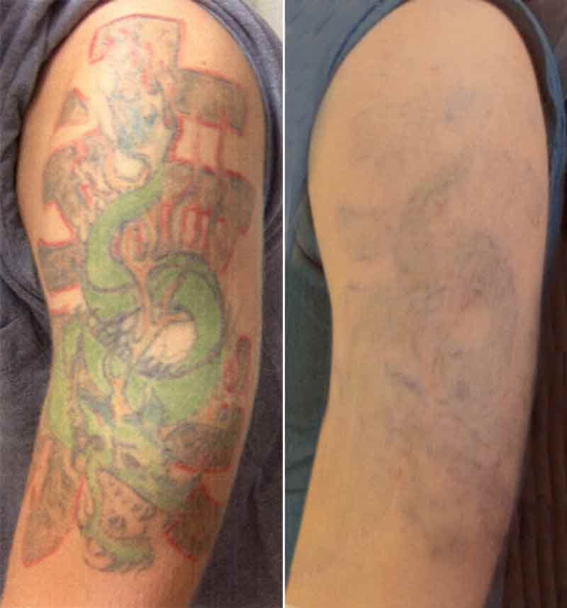 Laser Tattoo Removal | Contour Dermatology