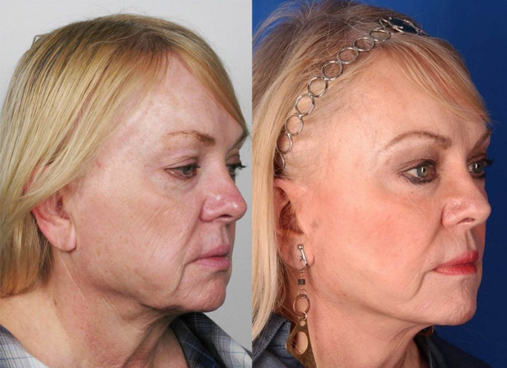 Contour Dermatology Mini Facelift by Dr Timothy Jochen | Contour ...