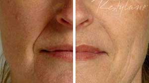 oday_ many people are showing increasing interest in correcting wrinkles and folds_ shaping facial contours and augmenting the lips. Restylane is a complete solution for tissue-tailored facial augmentation _ a natural beauty lift using the body_s own material.