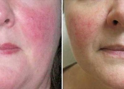 vBeamBeforeAfter1