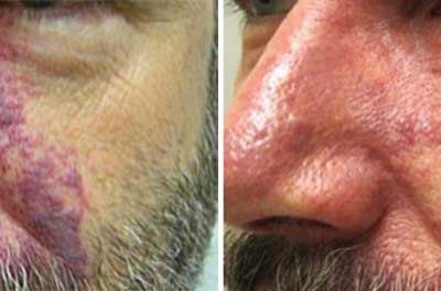 Vbeam Before/After Gallery