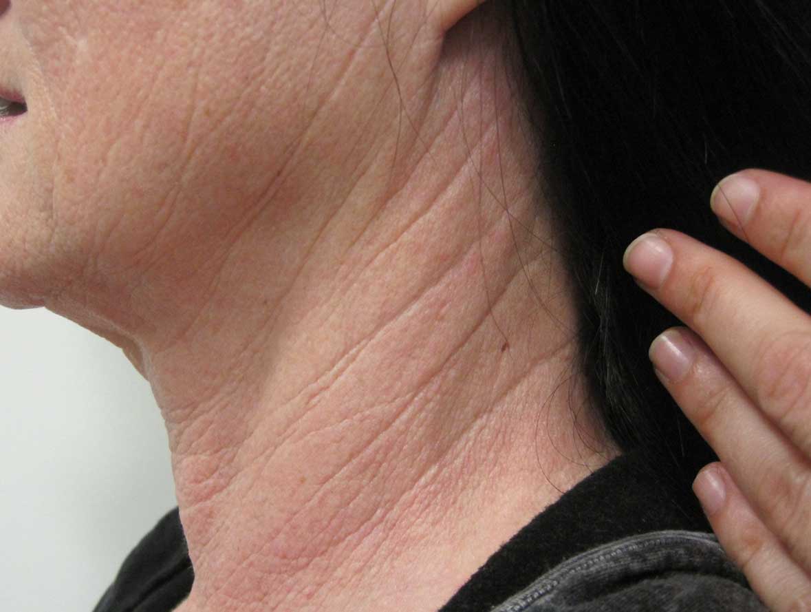 VelaShape III™ For Body Reshaping & Cellulite Reduction Contour