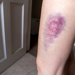 Bruises are a simple rupture of a blood vessel under the skin caused by a tear in the skin or a hard bump.