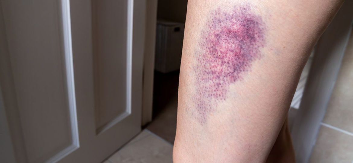 Bruises are a simple rupture of a blood vessel under the skin caused by a tear in the skin or a hard bump.