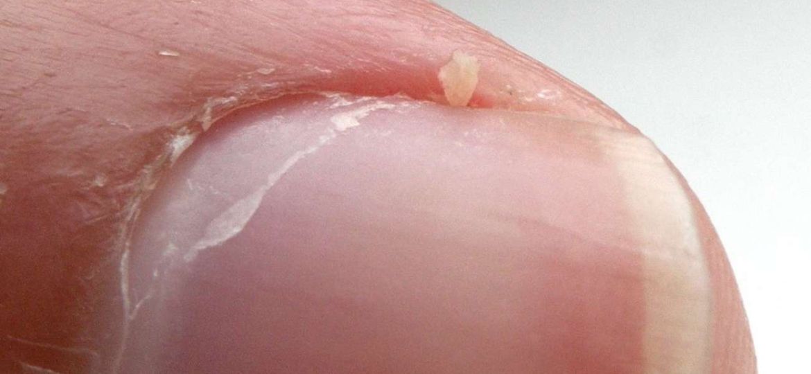 A Hangnail is a small piece of torn skin along our fingernails and or toenails. Hangnails are often the result of dry skin or nail biting.