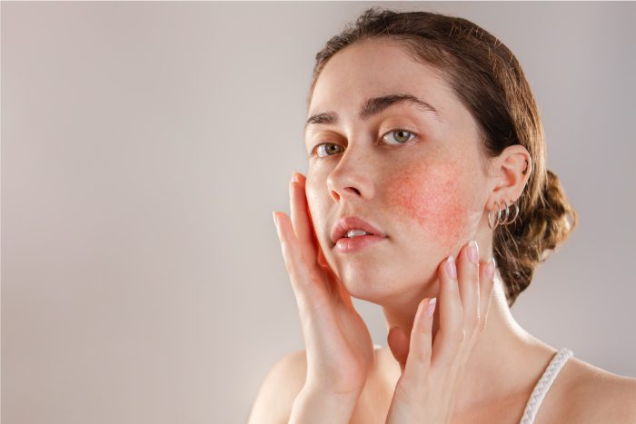 How to Treat Redness on the Face