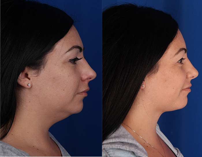 Chin lipo before and after