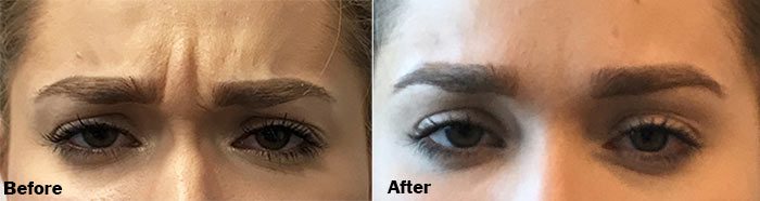 Botox – Relax Muscles, Reduce Fine Lines and Wrinkles