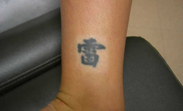 Tattoo Removal, Tattoo Off– Palm Springs, Palm Desert, Rancho Mirage and Santa Monica  Contour 