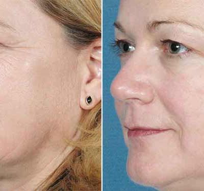 Sublime Laser for Face – Contour Dermatology Patient