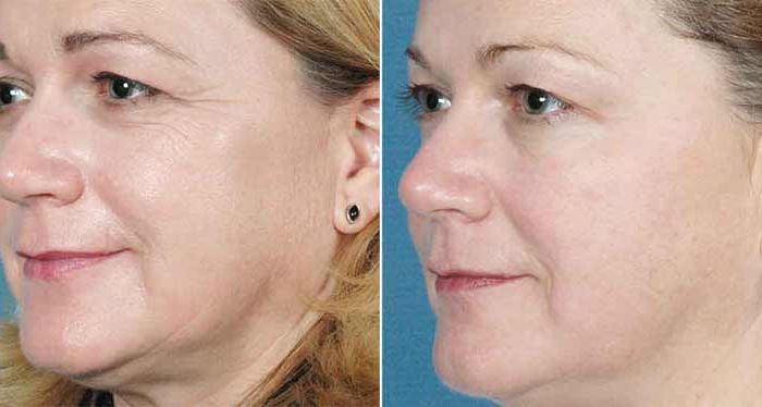 Sublime Laser for Face – Contour Dermatology Patient