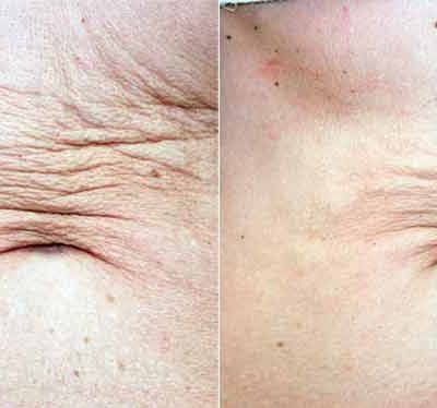 Sublime Before and After