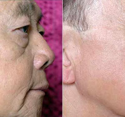 Sublime Before and After