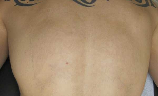 Tattoo Removal, Tattoo Off– Palm Springs, Palm Desert, Rancho Mirage and Santa Monica  Contour 
